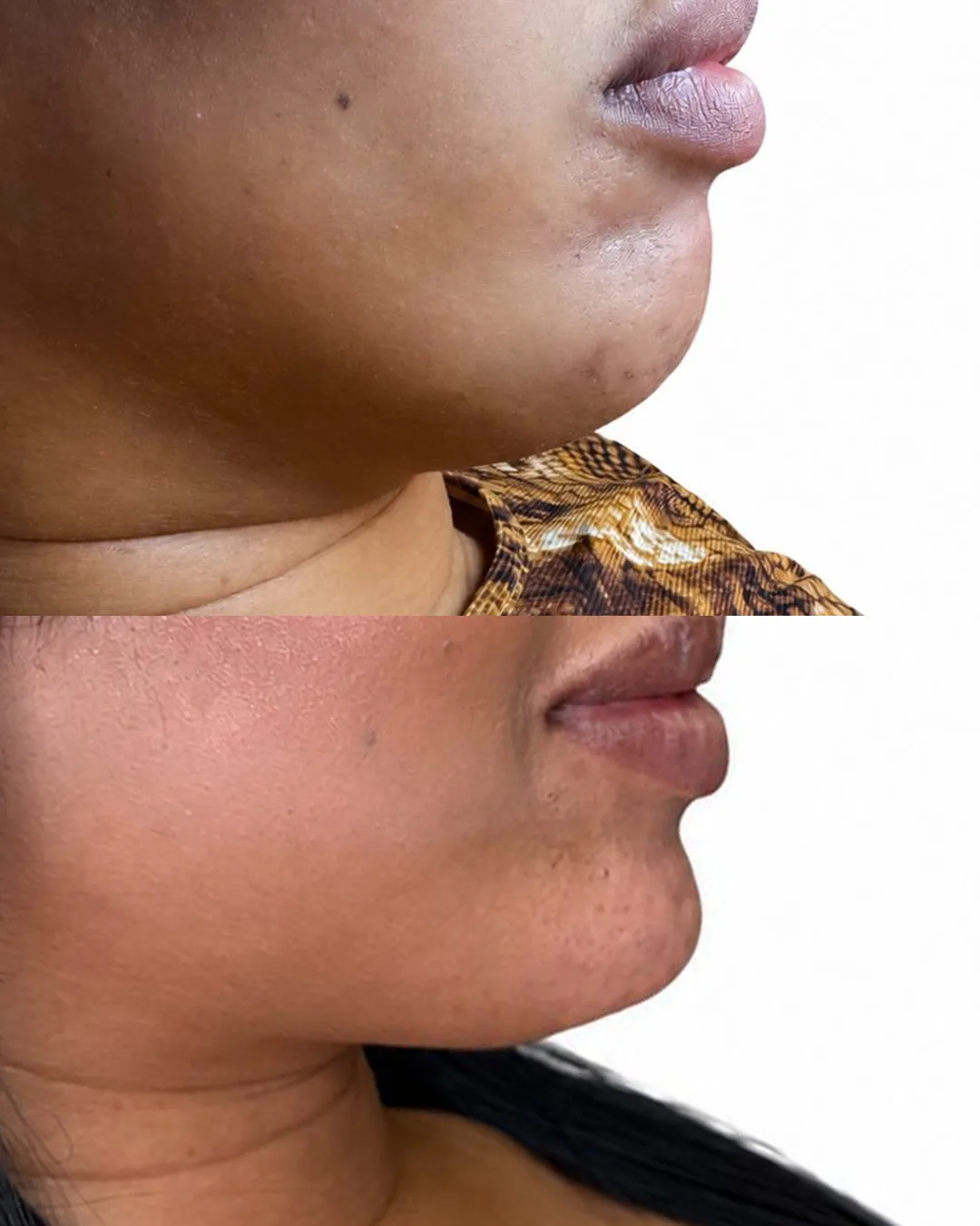 Facial harmonization before and after result